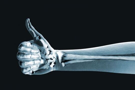 Рэнтгенаграфія дапаможа дыягнаставаць боль у суставах пальцаў рукі
